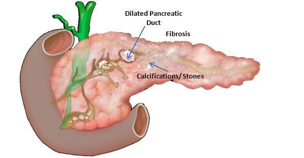Χαρακτηριστικά της χρόνιας παγκρεατίτιδας (πηγή: pancreapedia.org)