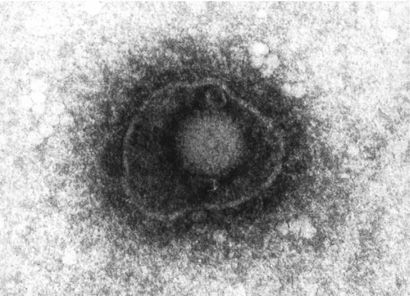 Φωτογραφία του ιού της ανεμοβλογιάς-ζωστήρα από ηλεκτρονικό μικροσκόπιο