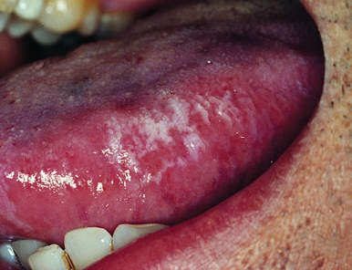 Η λευκοπλακία είναι μιά προκαρκινική βλάβη που εκδηλώνεται με λευκές κηλίδες ή πλάκες στο βλεννογόνο του στόματος, στα ούλα, την εσωτερική πλευρά των παρειών και μερικές φορές κάτω από τη γλώσσα που δεν απομακρύνονται με απόξεση και μπορεί να εξελιχθεί σε καρκίνο του στόματος